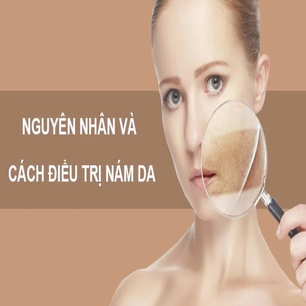 Bệnh Nám Da: Nguyên Nhân, Triệu Chứng và Cách Điều Trị