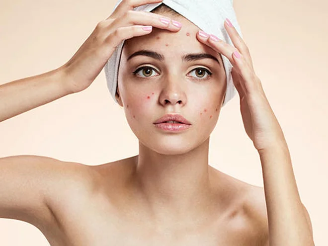 Quy trình skincare cho da dầu mụn ban ngày và ban đêm đúng cách